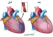 هشدار یک جراح قلب درباره سکته‌های زودرس