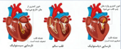 مهم ترین دلیل افزایش نارسایی قلبی چیست؟