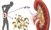 کشف جدید دانشمندان ایرانی برای دفع سنگ کلیه