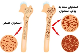 سن ابتلا به پوکی استخوان در زنان و مردان چقدر است؟
