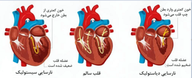 مهم ترین دلیل افزایش نارسایی قلبی چیست؟
