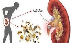 کشف جدید دانشمندان ایرانی برای دفع سنگ کلیه